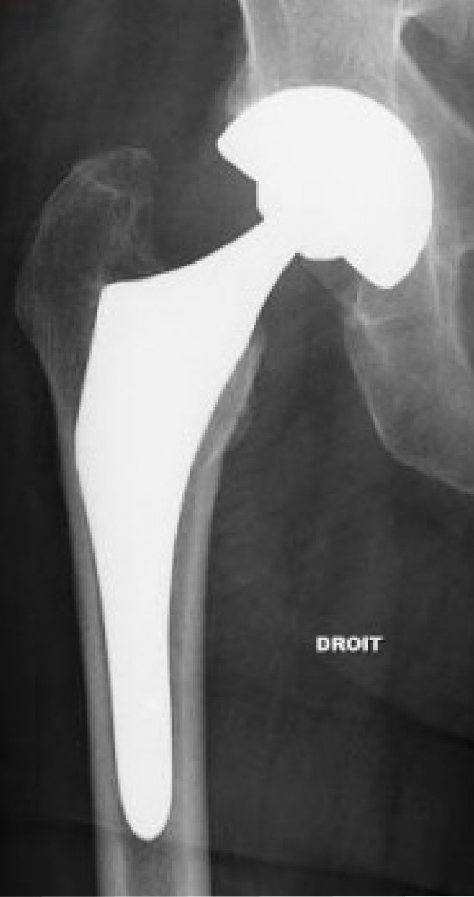 Les fractures de la hanche | Chirurgiens orthopédistes Cavaillon