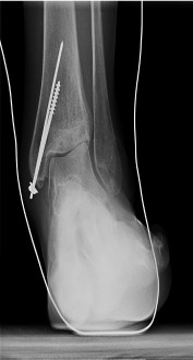 Arthrose de cheville