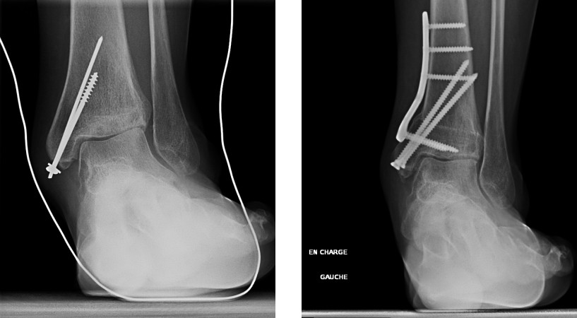 L'arthrose de cheville | Alpilles Luberon Orthopédie à Carpentras